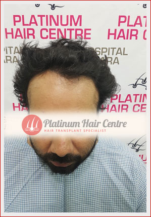 Hair Transplant Punjab