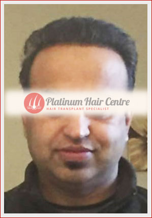 Hair Transplant Punjab
