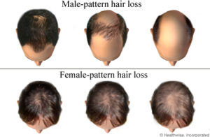 baldness pattern